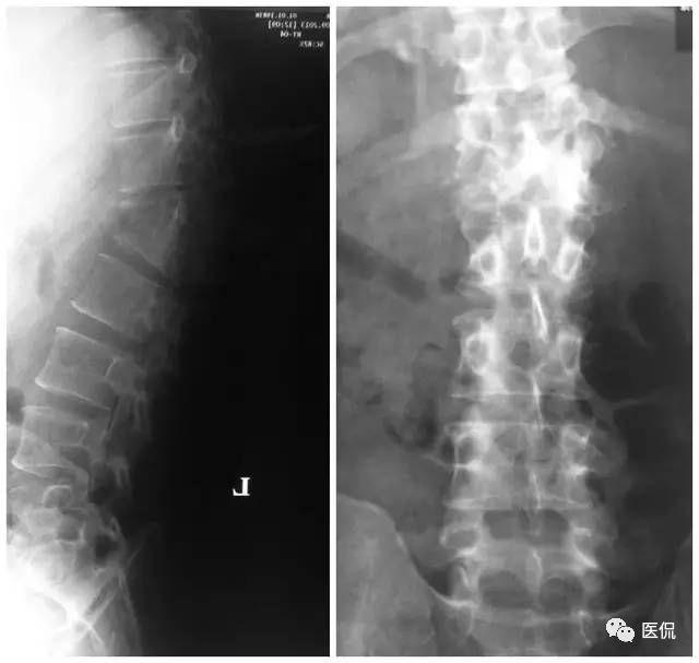 圖 7 腰椎正側位片結果顯示,t12 及 l1 椎體形態失常圖 8 腰椎 mri