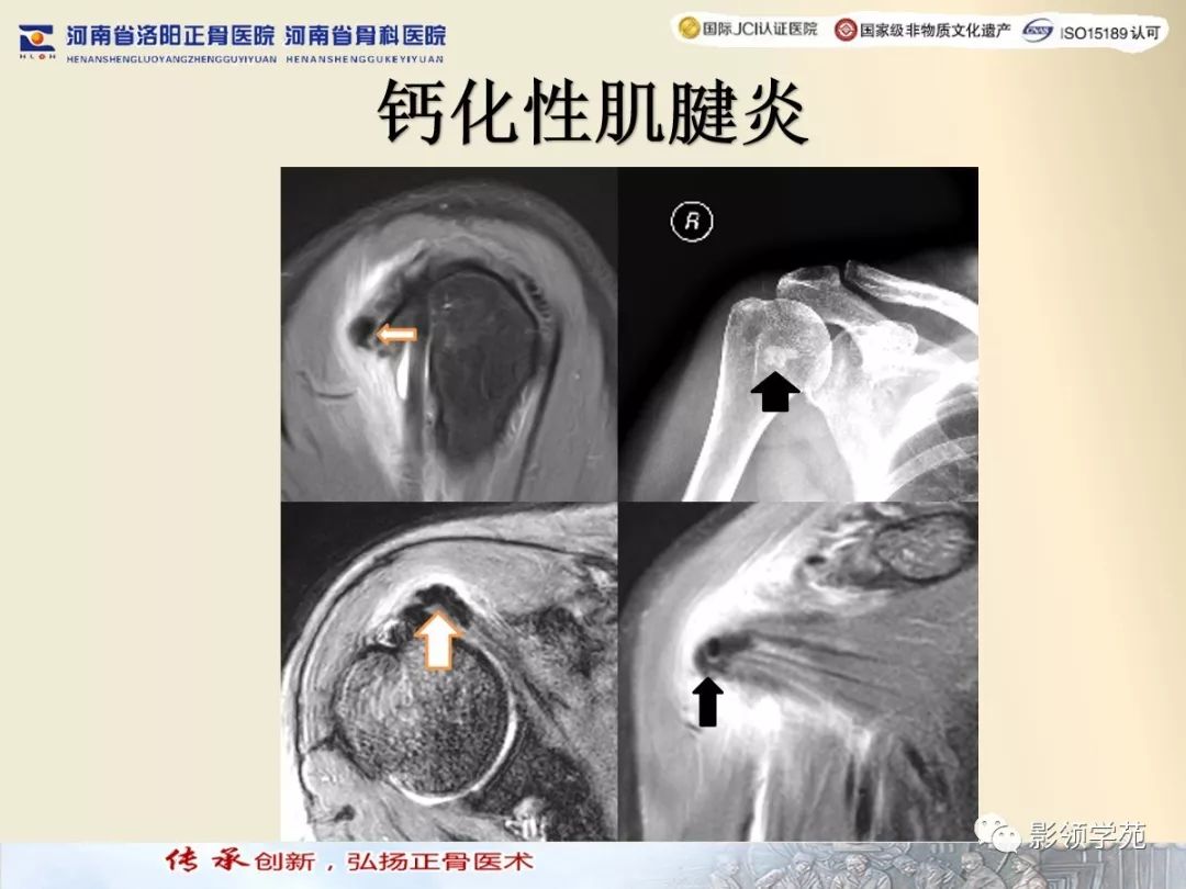 冈上肌腱钙化图片