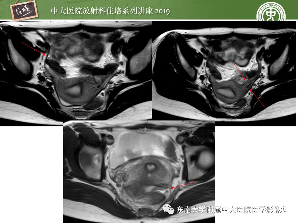 子宫MR解剖图片