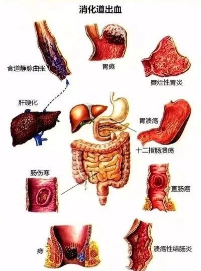 吐血拉血解黑便当心消化道出血