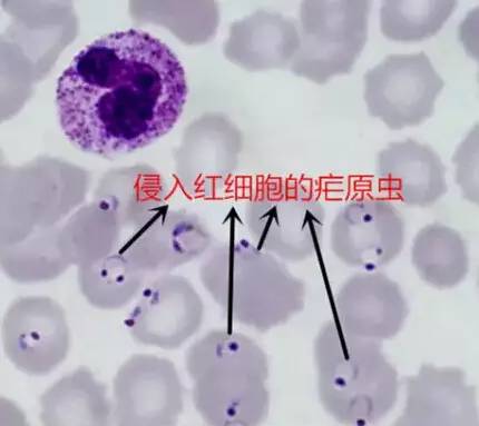 显微镜下侵入红细胞的疟原虫不同的疟原虫分别引起间日疟,三日疟,恶性