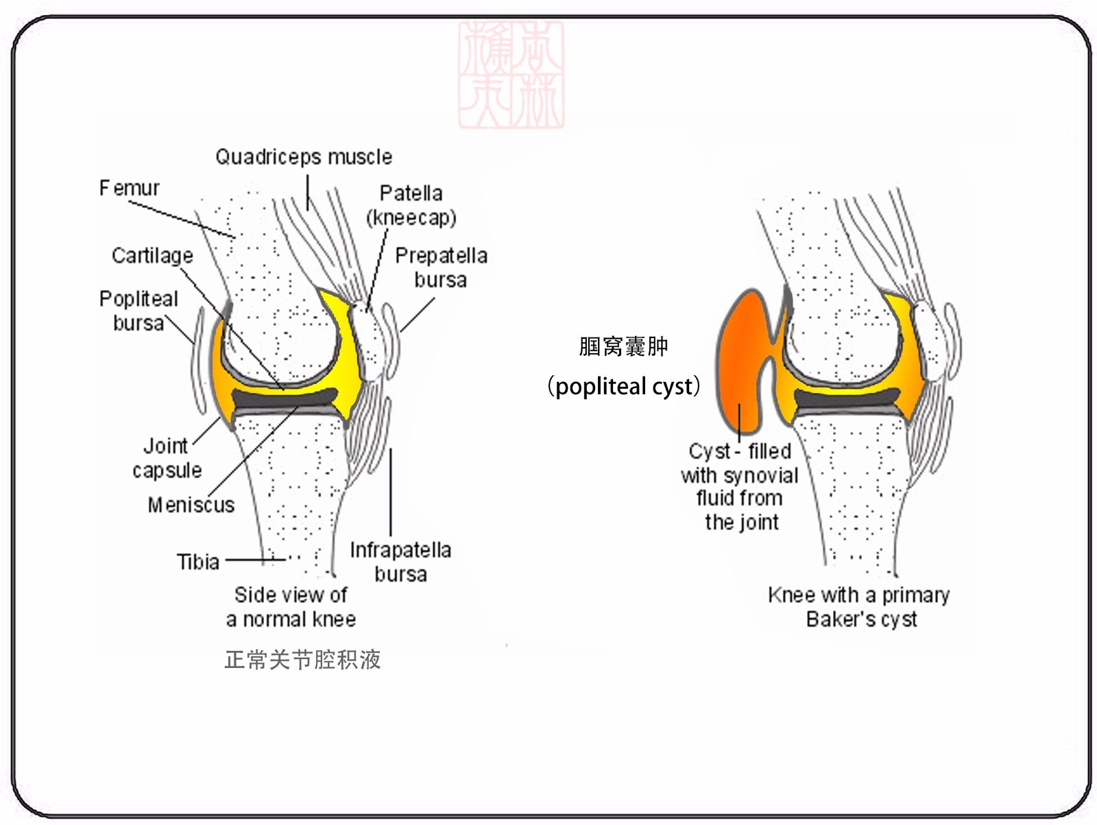 腘窝囊肿的微创治疗