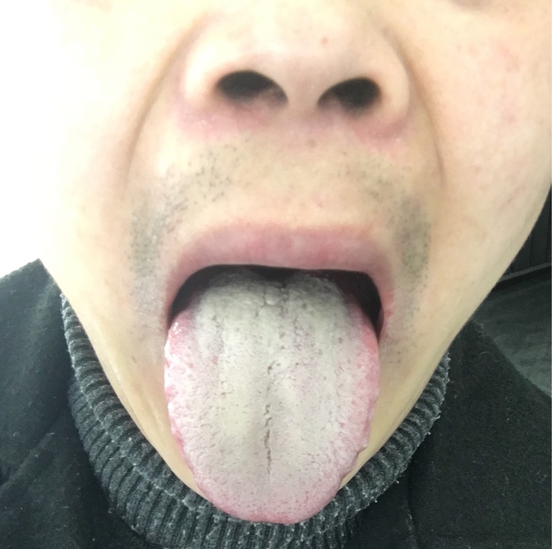 舌苔都是厚白苔那么其实这种舌头表现出来的就是身体里面湿寒很重的