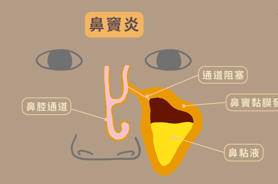 鼻窦炎的图片大全图片