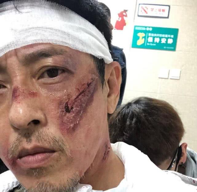 吕颂贤公开多张脸部受伤的照片,粉丝担心是不是遇到爆炸了