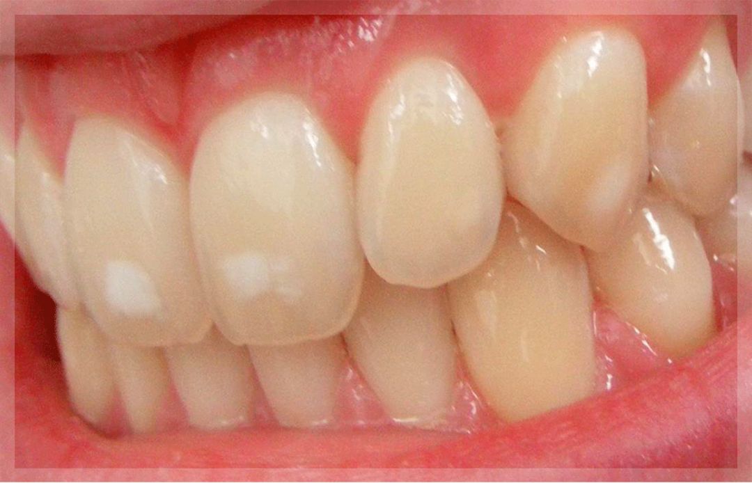 是现在国际公认最有效且最安全的牙齿美白方法,操作后牙齿颜色可提高5