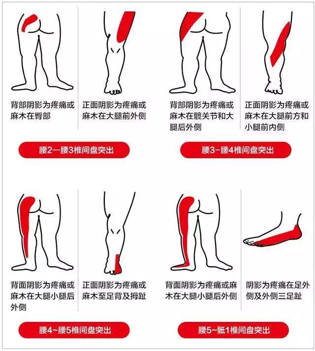 有的人活着,但他的腰椎已经死了……