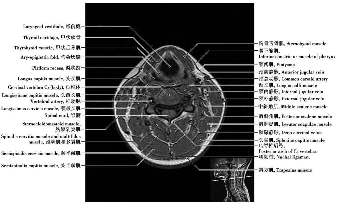 颈椎CT断层解剖图片