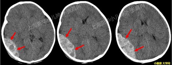 宝宝意外坠床,哪些情况需紧急送医?