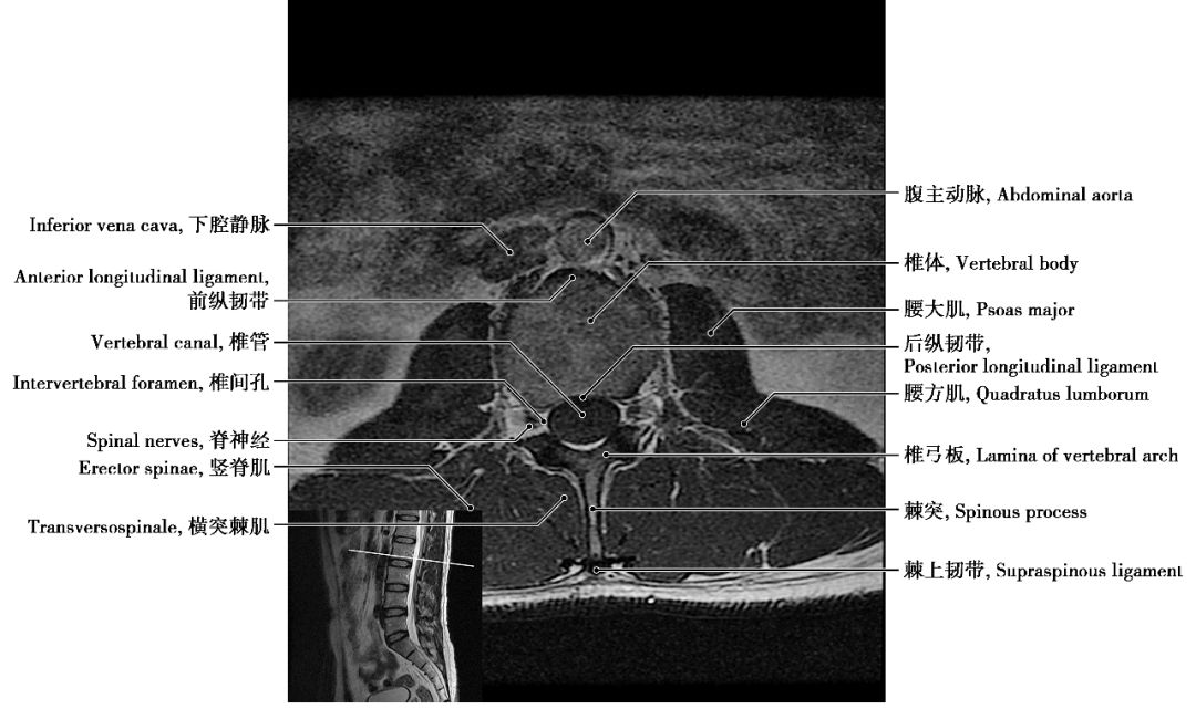 腰椎mri解剖图谱教学图片