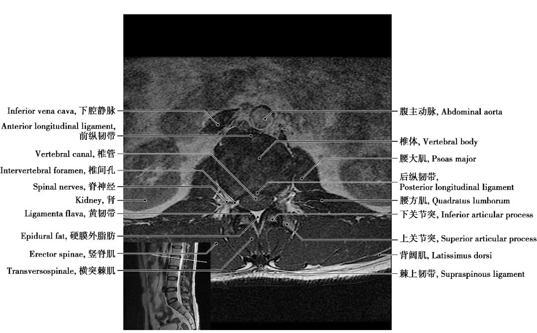 腰椎mri解剖图谱教学图片