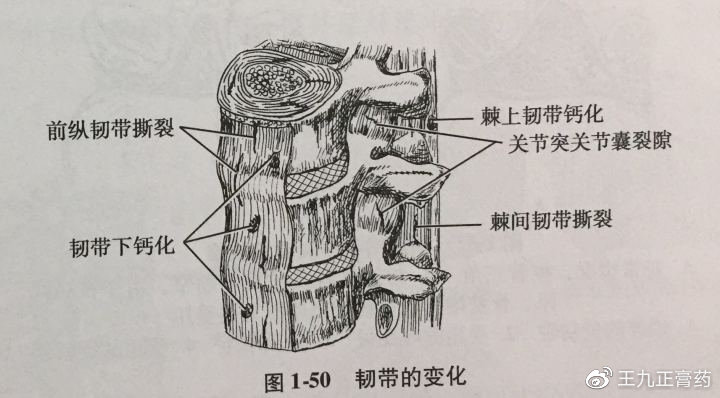 腰椎间盘突出症