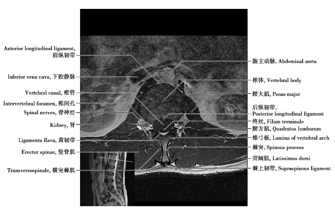 腰椎mri解剖图谱教学图片