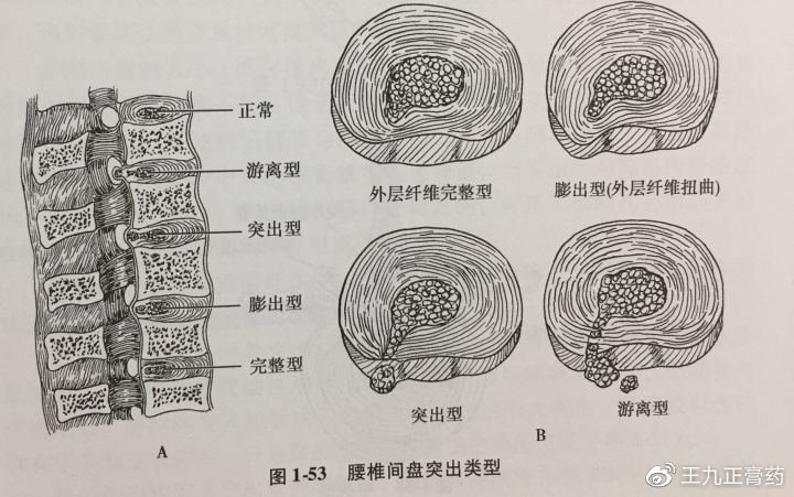 腰间盘突出病理示意图图片