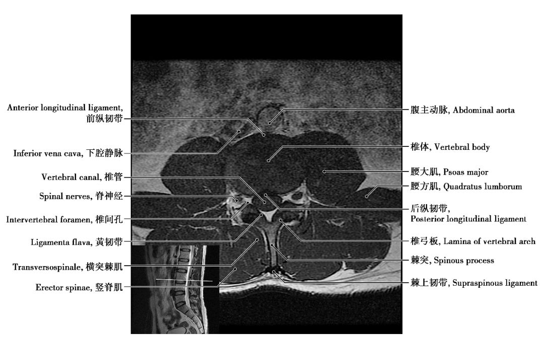 中樞神經系統影像解剖圖譜連載3腰椎mri概論t1wi軸位解剖圖