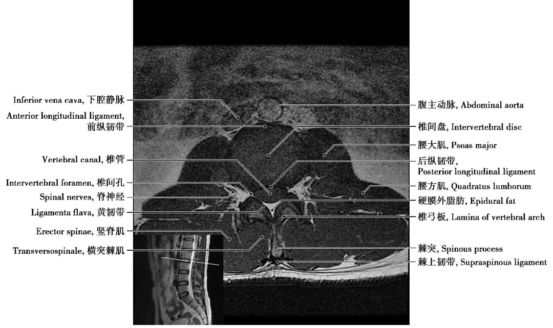 腰椎核磁解剖图谱图片
