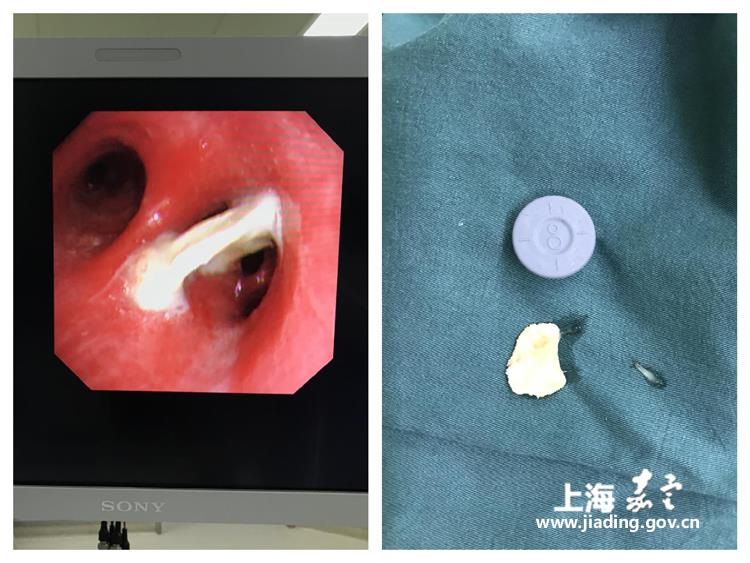 气管异物取出图片