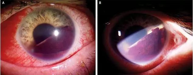 8岁,单眼结膜出血,是陪读妈妈打的;小男孩,7岁,外伤性前房积血,也是