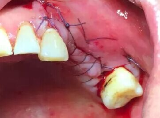 保定高难度种植牙案例牙槽骨宽度不足骨劈开术