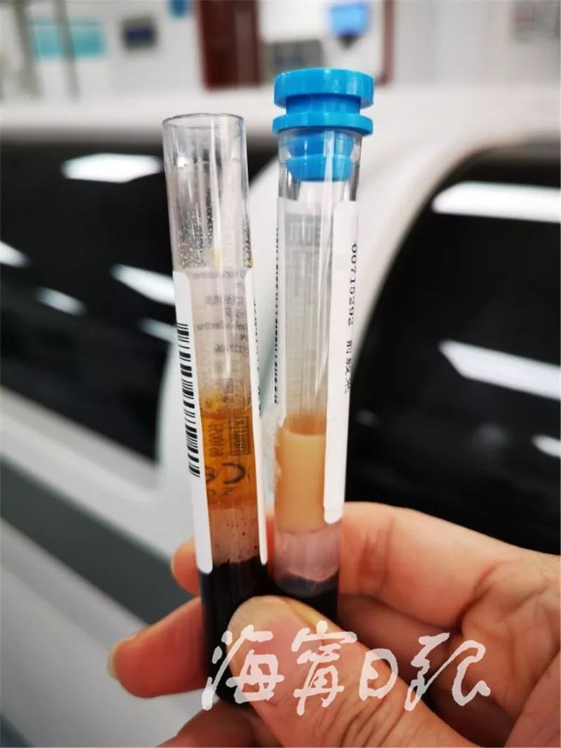 嘉兴海宁一男子血液竟是黄色的!他的这个坏习惯很多人会犯