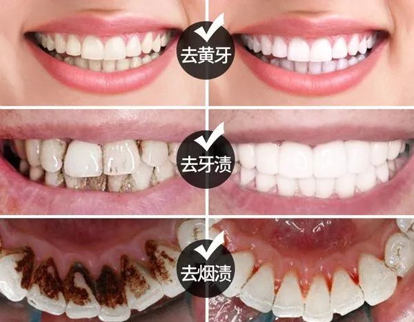 牙齿越刷越黄刷牙前加点黑粉牙齿白到发亮