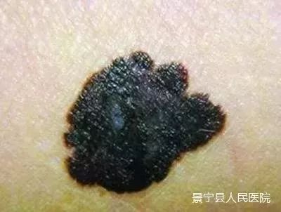 身上这种"黑痣"是癌前病变,吓得小编赶紧自查.