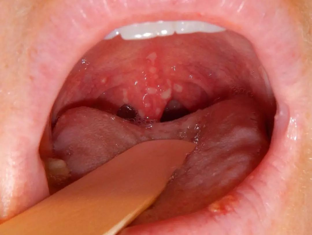 疱疹性咽峡炎即:孩子感染病毒后出现的一种急性上呼吸道传染病,会出现
