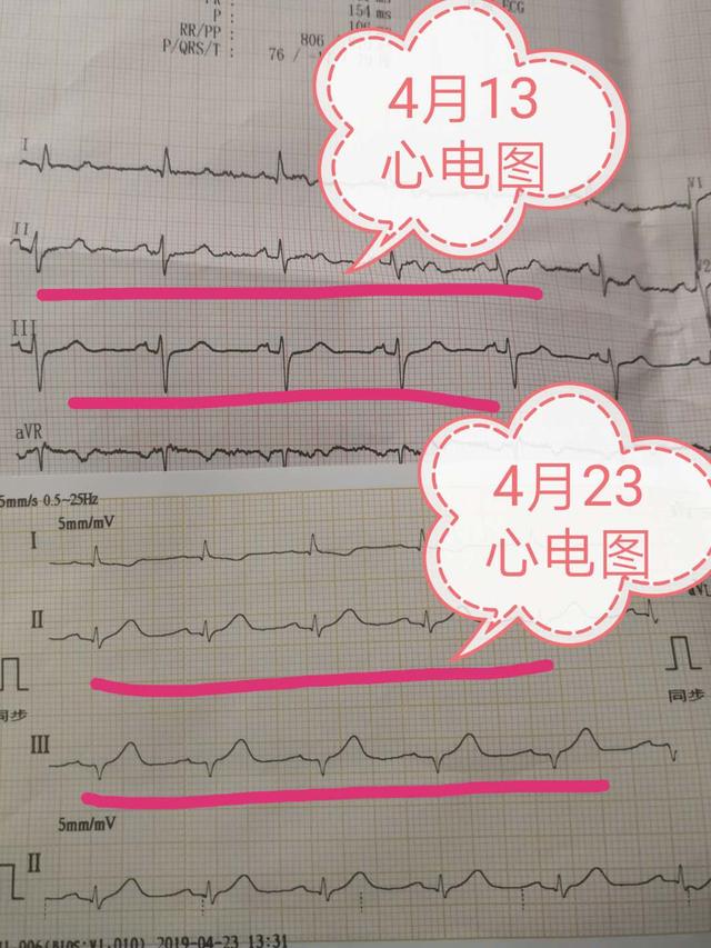 原创49岁,10天前检查心电图正常,现在突然心梗,120车上心脏停跳