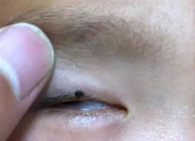 2岁男孩眼皮上突然冒出一个小黑点!医生:这东西会要命!