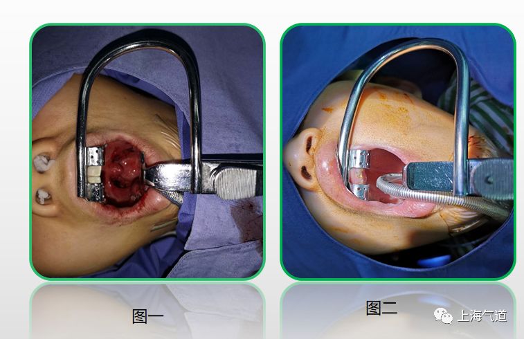 的位置(导管未被固定在压舌板下面)扁桃体增殖体切除术不是一个小手术