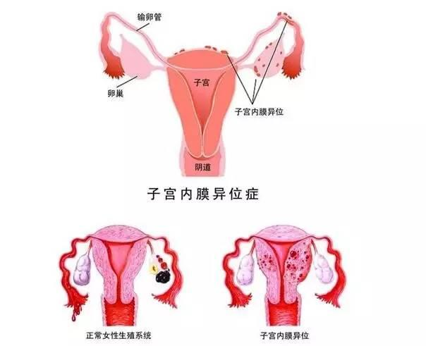 子宫内膜异位症,顾名思义,就是本来应该长在子宫腔的子宫内膜,长到了