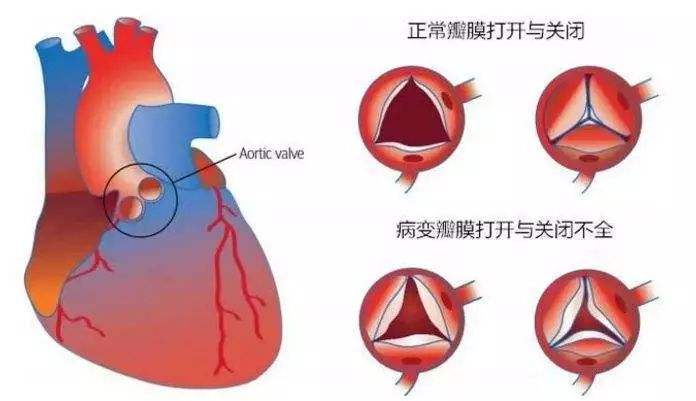 什么是风湿性心脏病?