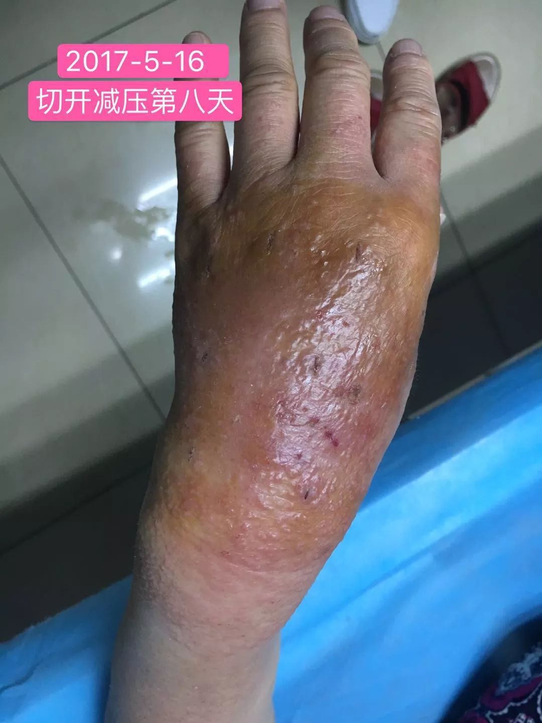 值得收藏造影剂外渗12种处理方法