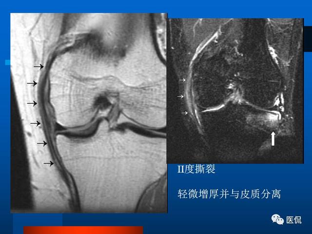 髌韧带断裂的mri图片图片