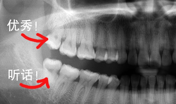 二胎妈妈阻生齿发炎险丧命!智齿到底要不要拔掉?