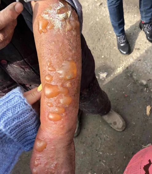 但胳膊和脸部却被严重烧伤.