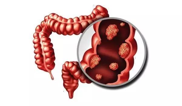 结肠炎到底会不会传染呢