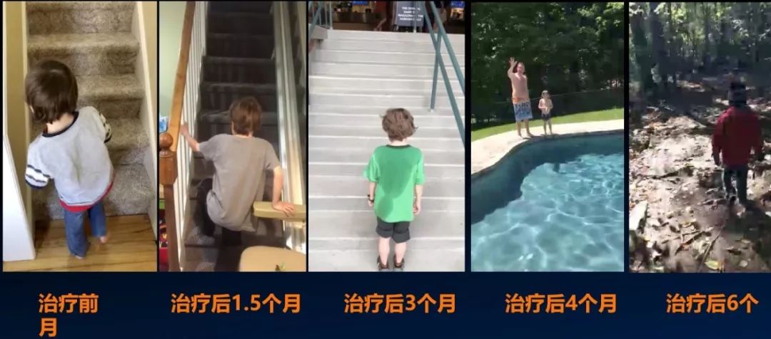 基因治疗的效果-杜氏肌营养不良症在facebook上可以找到,这是一个美国