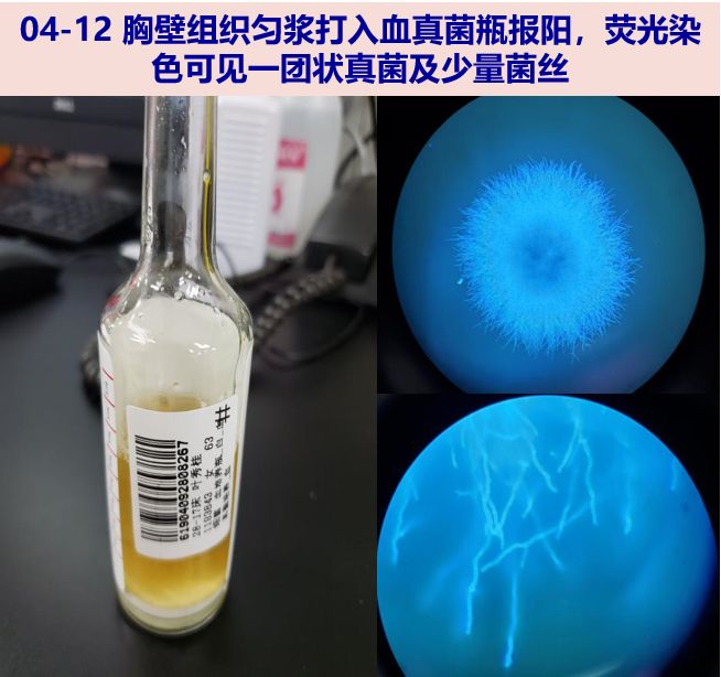 荧光染色可见一团状真菌及少量菌丝,转种sda平板,分置于25°及37