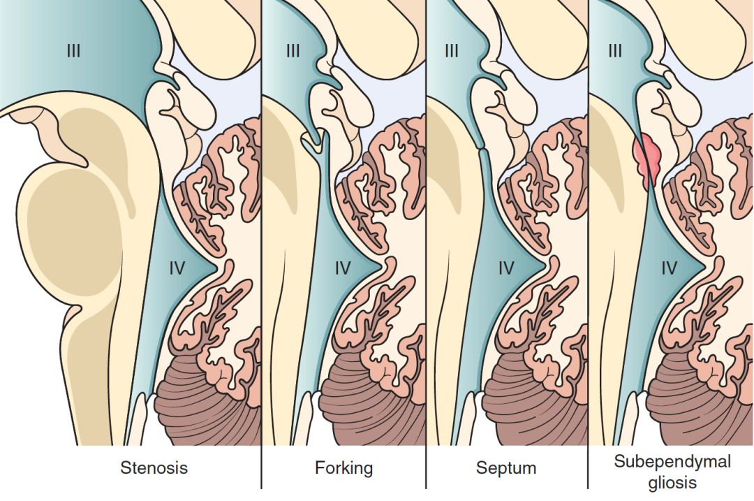 新生儿双胞胎低体重脑积水一对(小儿神经外科系列三)