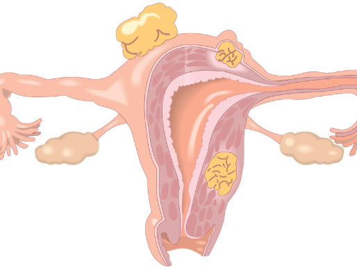 當懷孕遇上子宮肌瘤,準媽媽該怎麼辦?醫生:你不妨這樣做!