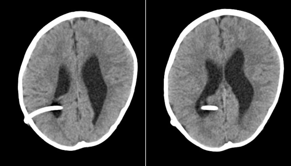 脑积水ct图片图片