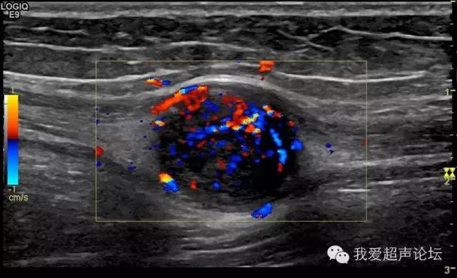 皮下纤维瘤超声声像图图片