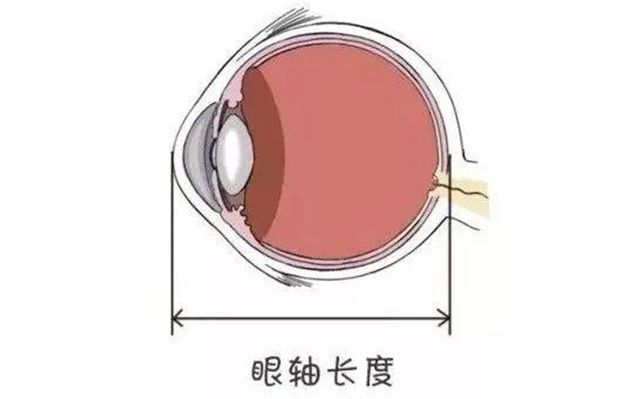 眼轴长度在近视防控中的作用