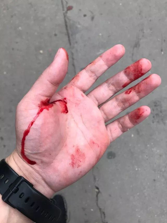 温州一民警抓捕中被刺伤鲜血直流