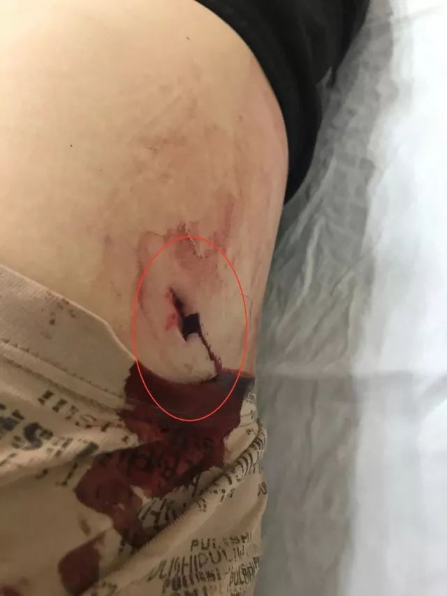 温州一民警抓捕中被刺伤鲜血直流