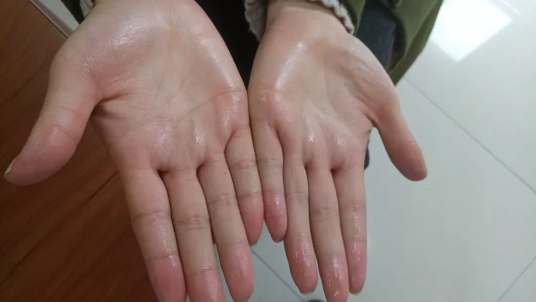 30岁小伙拥有一双会下雨的手困扰他二十余载的烦恼在这里轻松解决