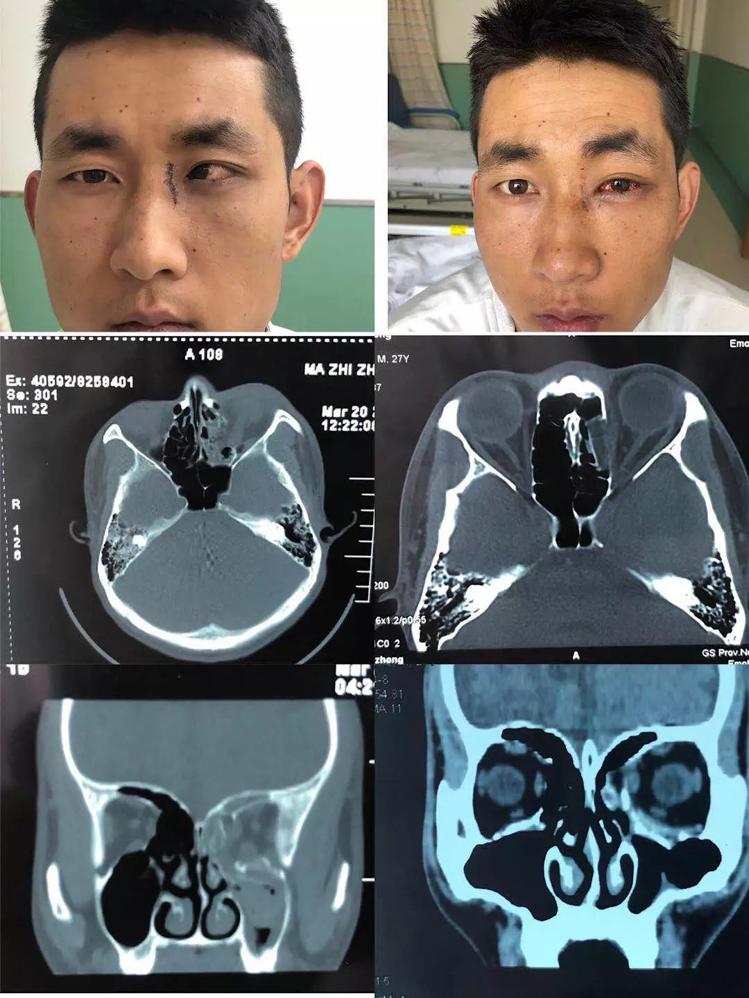 眼科病例分享 眼眶骨折导致大度数内斜视的手术矫正