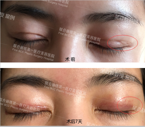 双眼皮最难看的不是菜刀割的肉条,而是闭眼凹陷型疤痕 (原创)_切口