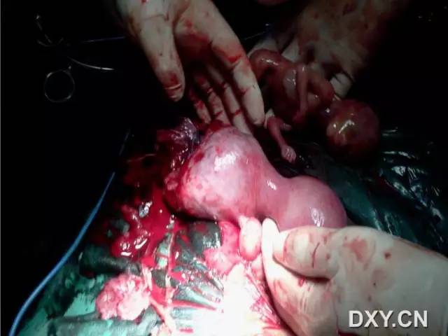 并破裂典型病例 2(由丁香园注册用户「快乐的阿辉」提供)患者女,孕 13